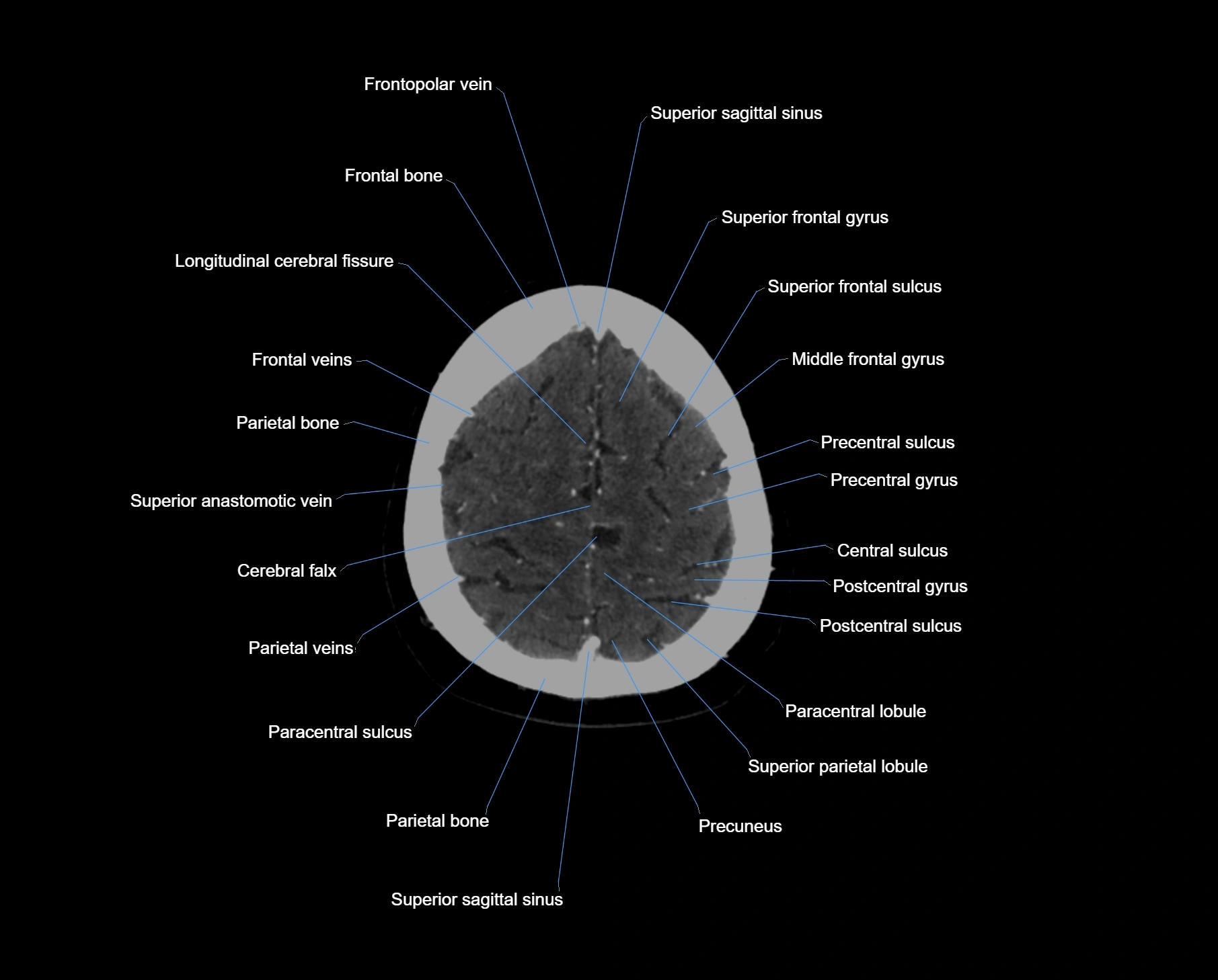 CT scan brain axial labelled cross sectional anatomy image-img-000061.webp